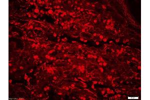 Formalin-fixed and paraffin-embedded human lung cancer labeled with Rabbit Anti-ERK5 (Ser731+Thr733) Polyclonal Antibody, Unconjugatedused at 1:200 dilution for 40 minutes at 37°C. (MAPK7 antibody  (pSer731, pThr733))