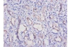 Immunohistochemistry of paraffin-embedded human kidney tissue using ABIN7177289 at dilution of 1:50 (HAVCR1 antibody  (AA 22-237))