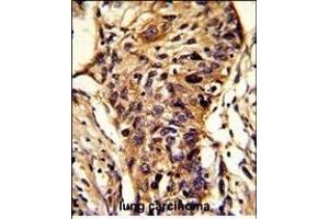 Formalin-fixed and paraffin-embedded human lung carcinoma reacted with BCKDHA Antibody (C-term), which was peroxidase-conjugated to the secondary antibody, followed by DAB staining. (BCKDHA antibody  (C-Term))