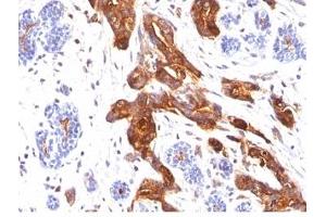 Formalin-fixed, paraffin-embedded human breast carcinoma stained with EMA antibody (MUC1/845). (MUC1 antibody)