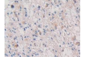 Detection of PALB in Human Glioma Tissue using Polyclonal Antibody to Prealbumin (PALB) (TTR antibody  (AA 21-147))