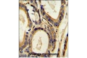 CCL4 Antibody (Center) (ABIN654131 and ABIN2850474) immunohistochemistry analysis in formalin fixed and paraffin embedded human prostate carcinoma followed by peroxidase conjugation of the secondary antibody and DAB staining. (CCL4 antibody  (AA 22-48))
