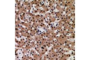Immunohistochemical analysis of TIP60 staining in human liver cancer formalin fixed paraffin embedded tissue section. (KAT5 antibody)