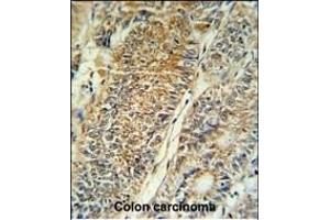 PYCR1 Antibody (C-term) (ABIN653849 and ABIN2843112) IHC analysis in formalin fixed and paraffin embedded colon carcinoma followed by peroxidase conjugation of the secondary antibody and DAB staining. (PYCR1 antibody  (C-Term))