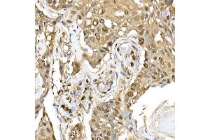 Immunohistochemistry of paraffin-embedded human esophageal cancer using ERK1/2 Rabbit mAb (ABIN7268620) at dilution of 1:100 (40x lens). (ERK1 antibody)