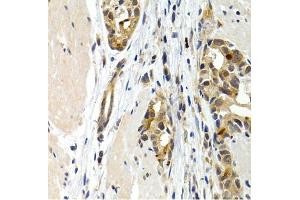 Immunohistochemistry of paraffin-embedded human stomach cancer using IL9 antibody (ABIN3015677, ABIN3015678, ABIN1680463 and ABIN6219030) at dilution of 1:200 (40x lens). (IL-9 antibody  (AA 19-144))