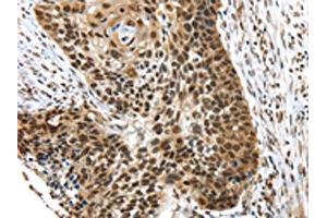 The image on the left is immunohistochemistry of paraffin-embedded Human esophagus cancer tissue using ABIN7192767(TEX37 Antibody) at dilution 1/40, on the right is treated with synthetic peptide.