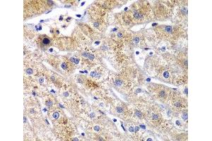 Immunohistochemistry of paraffin-embedded Human liver damage using DPP3 Polyclonal Antibody at dilution of 1:100 (40x lens). (DPP3 antibody)