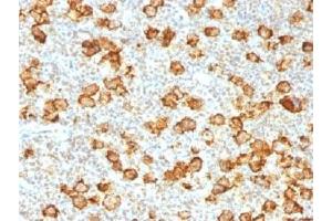 IHC testing of FFPE human Hodgkin's lymphoma stained with recombinant CD30 antibody (clone Ki-1/1505R).