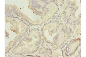 Immunohistochemistry of paraffin-embedded human prostate cancer using ABIN7159116 at dilution of 1:100 (MED18 antibody  (AA 35-208))