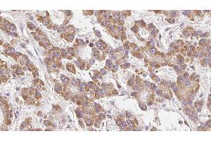 ABIN6279174 at 1/100 staining Human liver cancer tissue by IHC-P. (KCNJ10 antibody  (Internal Region))