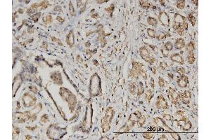 Immunoperoxidase of monoclonal antibody to EIF2S2 on formalin-fixed paraffin-embedded human pancreatic cancer.