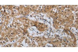 Immunohistochemistry of paraffin-embedded Human lung cancer tissue using PTPRM Polyclonal Antibody at dilution 1:40 (PTPRM antibody)