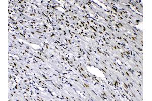 Emerin was detected in paraffin-embedded sections of human intetsinal cancer tissues using rabbit anti- Emerin Antigen Affinity purified polyclonal antibody (Catalog # ) at 1 µg/mL.