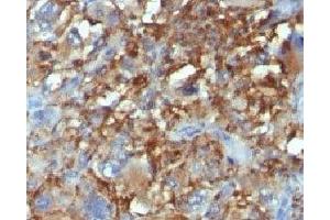 Formalin-fixed, paraffin-embedded human Histiocytoma stained with CD68 antibody. (CD68 antibody)