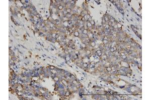 Immunoperoxidase of monoclonal antibody to LGALS4 on formalin-fixed paraffin-embedded human ovarian cancer. (GAL4 antibody  (AA 51-150))