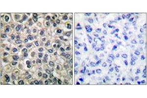 Immunohistochemistry analysis of paraffin-embedded human breast carcinoma tissue, using Catenin-gamma Antibody.