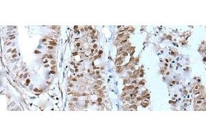 Immunohistochemistry of paraffin-embedded Human liver cancer tissue using ZNHIT3 Polyclonal Antibody at dilution of 1:80(x200) (ZNHIT3 antibody)