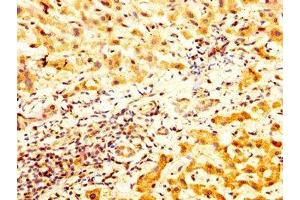 IHC image of ABIN7171412 diluted at 1:800 and staining in paraffin-embedded human liver cancer performed on a Leica BondTM system. (TCP1 alpha/CCTA antibody  (AA 406-506))