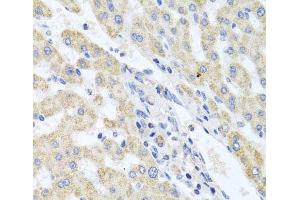 Immunohistochemistry of paraffin-embedded Human liver damage using ITPKB Polyclonal Antibody at dilution of 1:100 (40x lens). (ITPKB antibody)