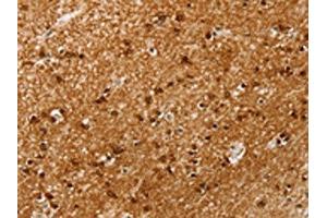 The image on the left is immunohistochemistry of paraffin-embedded Human brain tissue using ABIN7192664(SSX4 Antibody) at dilution 1/20, on the right is treated with synthetic peptide. (SSX4 antibody)
