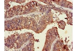 Immunohistochemistry of paraffin-embedded human endometrial cancer using ABIN7173463 at dilution of 1:100