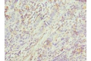 Immunohistochemistry of paraffin-embedded human bladder cancer using ABIN7153264 at dilution of 1:100 (FGD5 antibody  (AA 1203-1462))