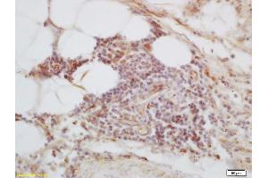 Formalin-fixed and paraffin embedded human lung carcinoma labeled with Anti-C1orf106 Polyclonal Antibody, Unconjugated (ABIN1713713) at 1:200 followed by conjugation to the secondary antibody and DAB staining (C1ORF106 antibody  (AA 601-663))