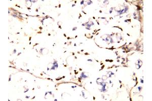 Anti-IFITM1 antibody, IHC(P) IHC(P): Human Intestinal Cancer Tissue (IFITM1 antibody  (N-Term))