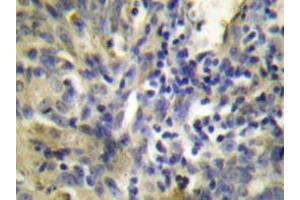 Immunohistochemistry analyzes of Cystatin A antibody in paraffin-embedded human lung carcinoma tissue. (CSTA antibody)