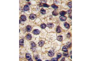 Formalin-fixed and paraffin-embedded human prostata carcinoma tissue reacted with PDGFRA Antibody  f , which was peroxidase-conjugated to the secondary antibody, followed by DAB staining.