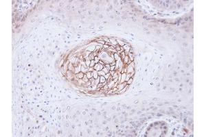 IHC-P Image Immunohistochemical analysis of paraffin-embedded Cal27 xenograft, using c-Met, antibody at 1:100 dilution. (c-MET antibody  (C-Term))
