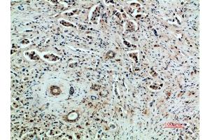 Immunohistochemical analysis of paraffin-embedded human-breast-cancer, antibody was diluted at 1:200. (VEGFR2/CD309 antibody  (AA 1268-1341))