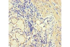 Immunohistochemistry of paraffin-embedded human gastric cancer using ABIN7148597 at dilution of 1:100