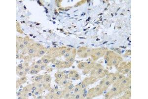 Immunohistochemistry of paraffin-embedded Human liver damage using LETMD1 Polyclonal Antibody at dilution of 1:100 (40x lens). (LETMD1 antibody)