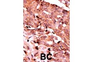 Formalin-fixed and paraffin-embedded human cancer tissue reacted with the primary antibody, which was peroxidase-conjugated to the secondary antibody, followed by AEC staining. (Caspase 6 antibody  (pSer257))
