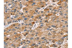 The image on the left is immunohistochemistry of paraffin-embedded Human liver cancer tissue using ABIN7131211(STARD8 Antibody) at dilution 1/30, on the right is treated with fusion protein. (STARD8 antibody)