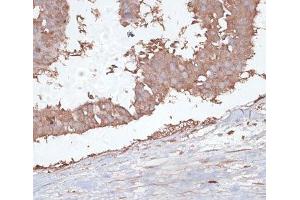Immunohistochemistry of paraffin-embedded Human mammary cancer using TGFBR2 Polyclonal Antibody at dilution of 1:100 (40x lens).