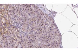 ABIN6273293 at 1/100 staining Human pancreas cancer tissue by IHC-P. (PDIA6 antibody  (C-Term))
