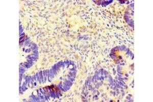Immunohistochemistry of paraffin-embedded human ovarian cancer using ABIN7173691 at dilution of 1:100 (TUBB4 antibody  (AA 1-444))