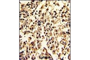 Formalin-fixed and paraffin-embedded human lymph with SERPINA9 Antibody (Center), which was peroxidase-conjugated to the secondary antibody, followed by DAB staining. (SERPINA9 antibody  (AA 194-222))