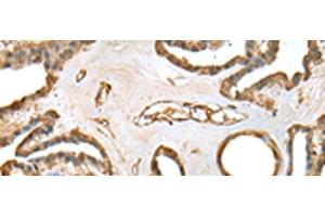 Immunohistochemistry of paraffin-embedded Human thyroid cancer tissue using SFN Polyclonal Antibody at dilution of 1:25(x200) (14-3-3 sigma/SFN antibody)