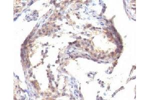 IHC testing of FFPE human testicular carcinoma with TGF alpha antibody