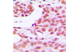 Immunohistochemical analysis of HOXD12 staining in human breast cancer formalin fixed paraffin embedded tissue section. (HOXD12 antibody  (C-Term))