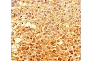 Immunohistochemistry of paraffin-embedded human melanoma using ABIN7154056 at dilution of 1:100 (GCDH antibody  (AA 45-300))