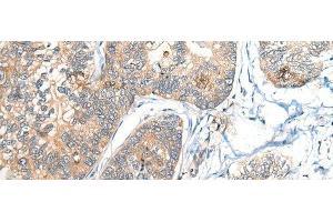 Immunohistochemistry of paraffin-embedded Human gastric cancer tissue using BCAN Polyclonal Antibody at dilution of 1:35(x200) (BCAN antibody)
