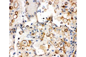 Anti-Integrin alpha 1 antibody,  IHC(P) IHC(P): Human Lung Cancer Tissue (Integrin alpha 1 antibody  (C-Term))