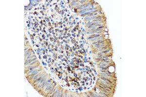 Immunohistochemistry of paraffin-embedded human lung cancer using /IB Rabbit pAb (2391) at dilution of 1:50 (40x lens). (Iba1 antibody  (AA 1-147))