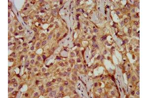 IHC image of ABIN7149571 diluted at 1:200 and staining in paraffin-embedded human liver cancer performed on a Leica BondTM system. (PDSS2 antibody  (AA 292-387))