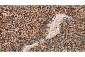 Immunohistochemistry of paraffin-embedded Human liver cancer using MMP1 Polyclonal Antibody at dilution of 1:60 (MMP1 antibody)